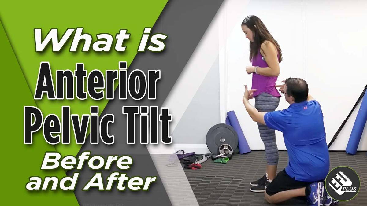 What is Anterior Pelvic Tilt Before and After