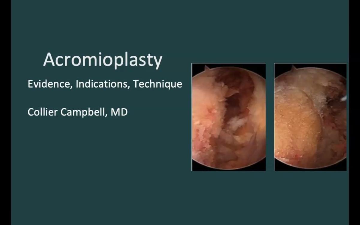 Arthroscopic Acromioplasty: Indication &amp; Techniquee