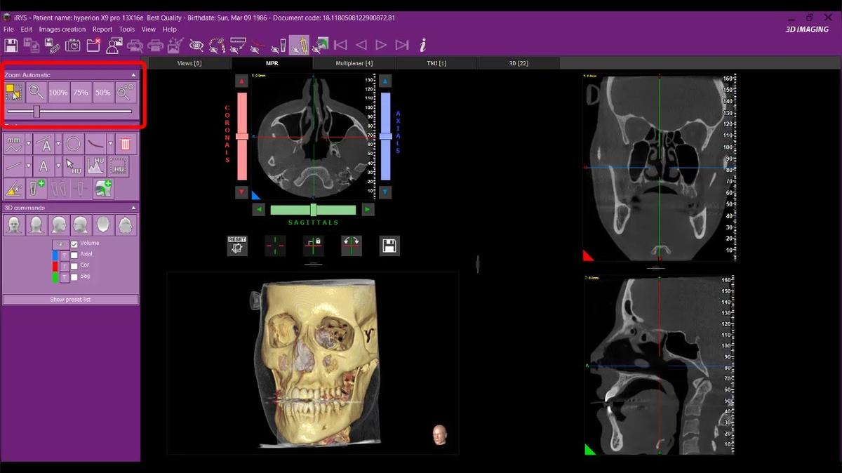 iRYS 11 - Navigating the MPR Screen