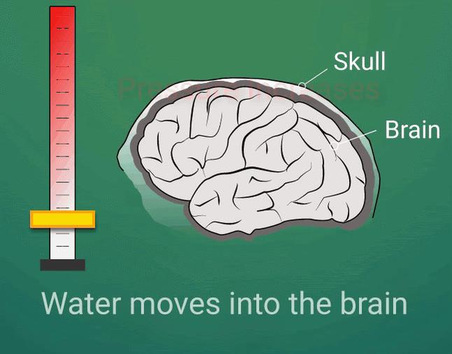 Brain Pressure Increase