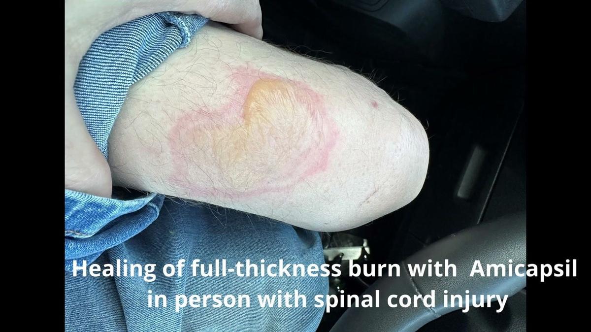 Full-thickness burn in SCI-person