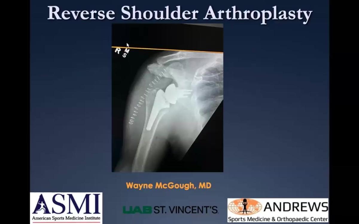 Reverse Total Shoulder Arthroplasty