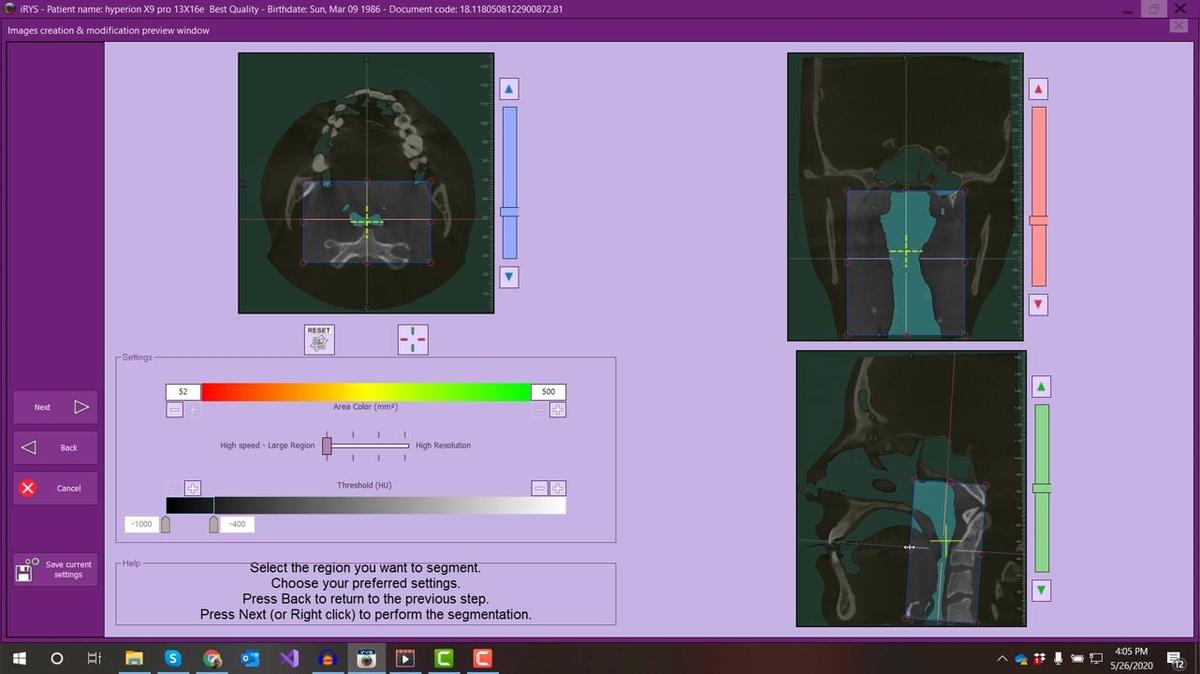 iRYs 11 - Visualizing the Airway