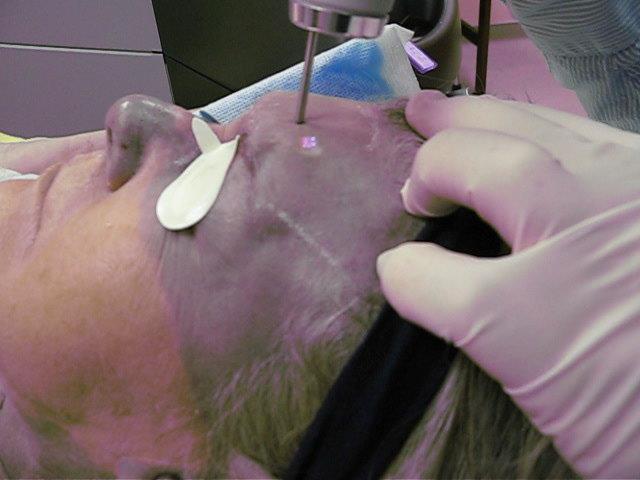 Argyria Treatment w/ the Astanza Trinity