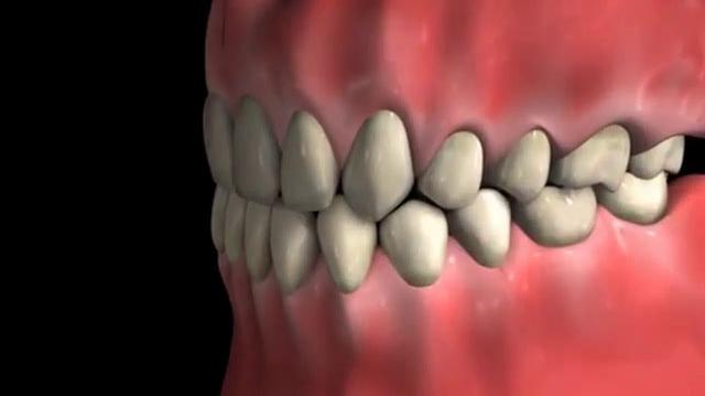 Root_Canal_Procedure_-_Molar.mp4