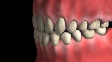 Root_Canal_Procedure_-_Molar.mp4