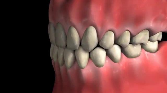 Root_Canal_Procedure_-_Molar.mp4