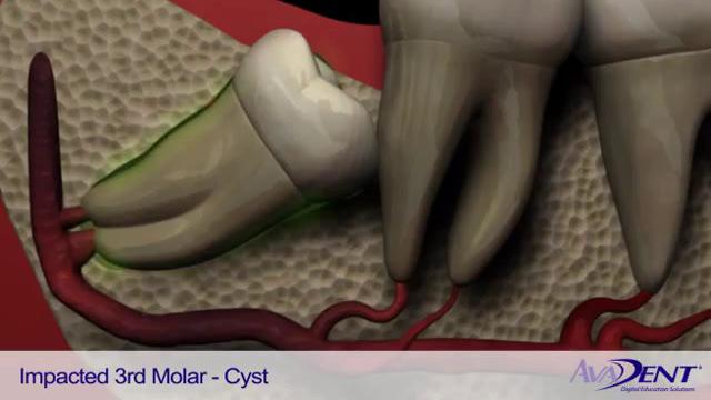 Impacted_3rd_Molar_-_Cyst.mp4