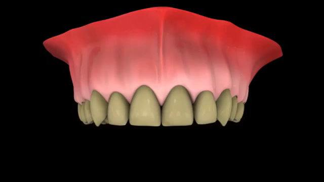 whitening_with_trays.mp4