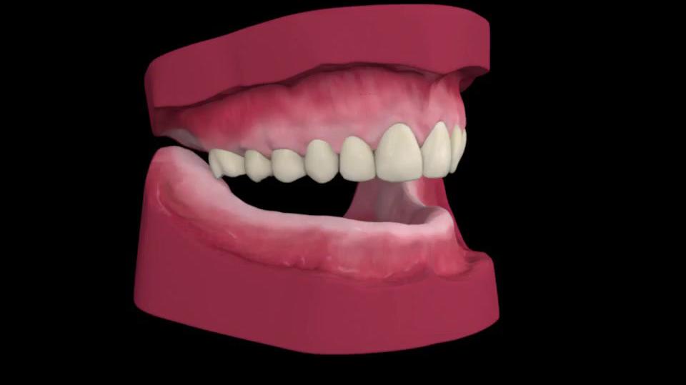 avadent_denture_with_two_implants_small.mp4