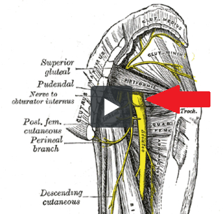 Sciatic Nerve Adhesion: Patient Education | Integrativediagnosis