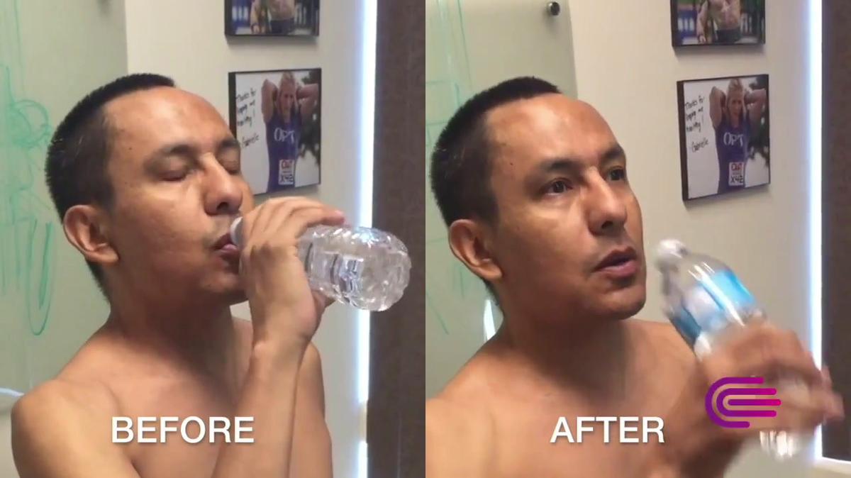 Essential Tremor patient before/after E+