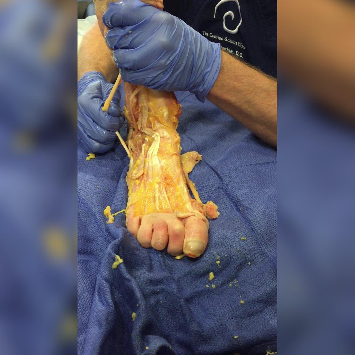 2018.AF.2.Basic.Foot Ankle Dissection 2 by Jason Markle DO.MOV