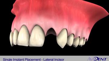 Single_Implant_Placement_-_Lateral_Incisor.mp4