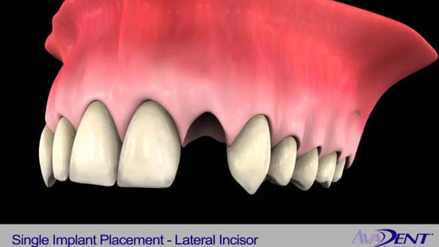 Single_Implant_Placement_-_Lateral_Incisor.mp4