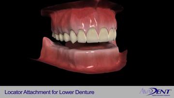 Locator_Attachments_for_Lower_Denture.mp4