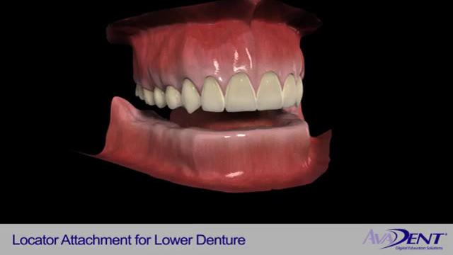 Locator_Attachments_for_Lower_Denture.mp4