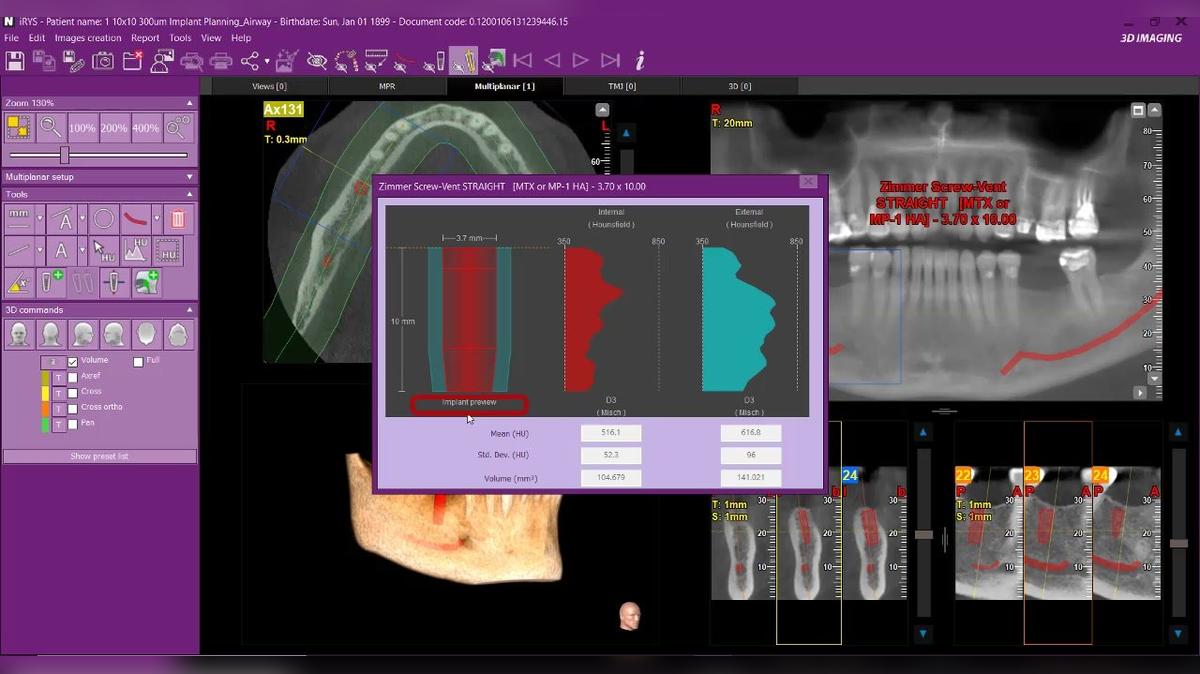 iRYS 11 - Implant Tool