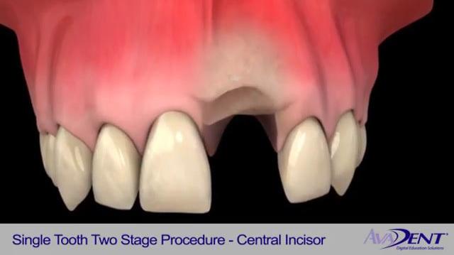 Single_Tooth_Two_Stage_Procedure_-_Central_Incisor.mp4