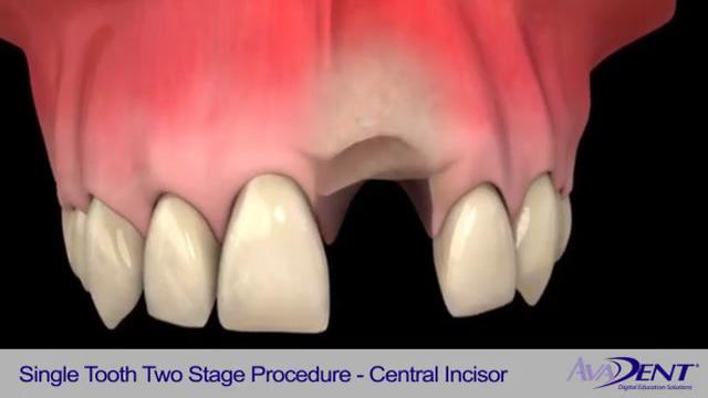 Single_Tooth_Two_Stage_Procedure_-_Central_Incisor.mp4