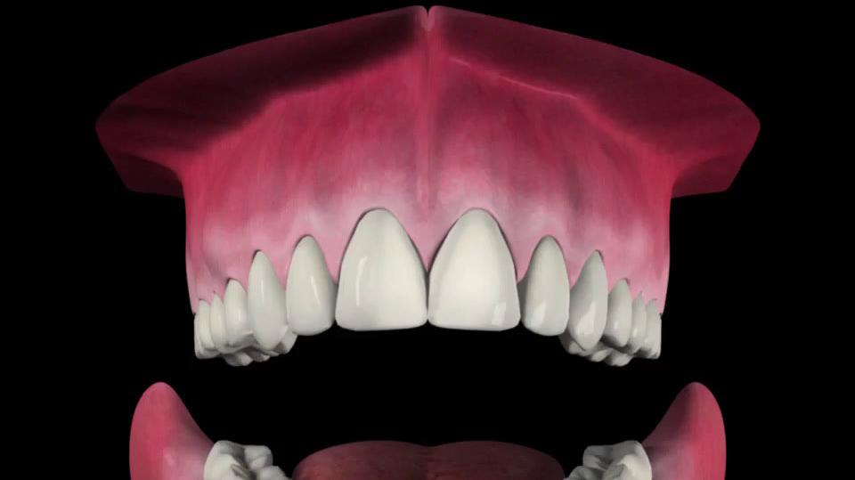 Bone_Grafting_-_Socket_Preservation.mp4