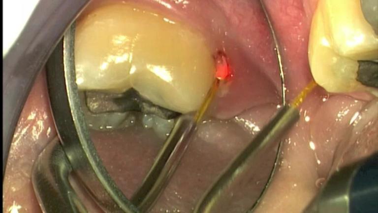 Laser-Assisted Treatment of Gum Disease- LANAP