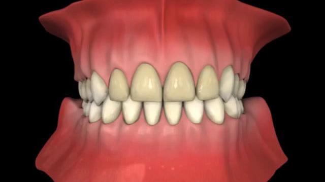 Veneers.mp4