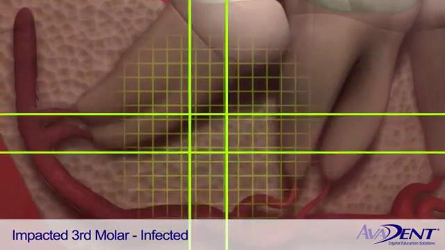 Impacted 3rd Molar - Infected