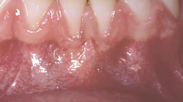 connective_tissue_graft_-_lower_teeth.mp4