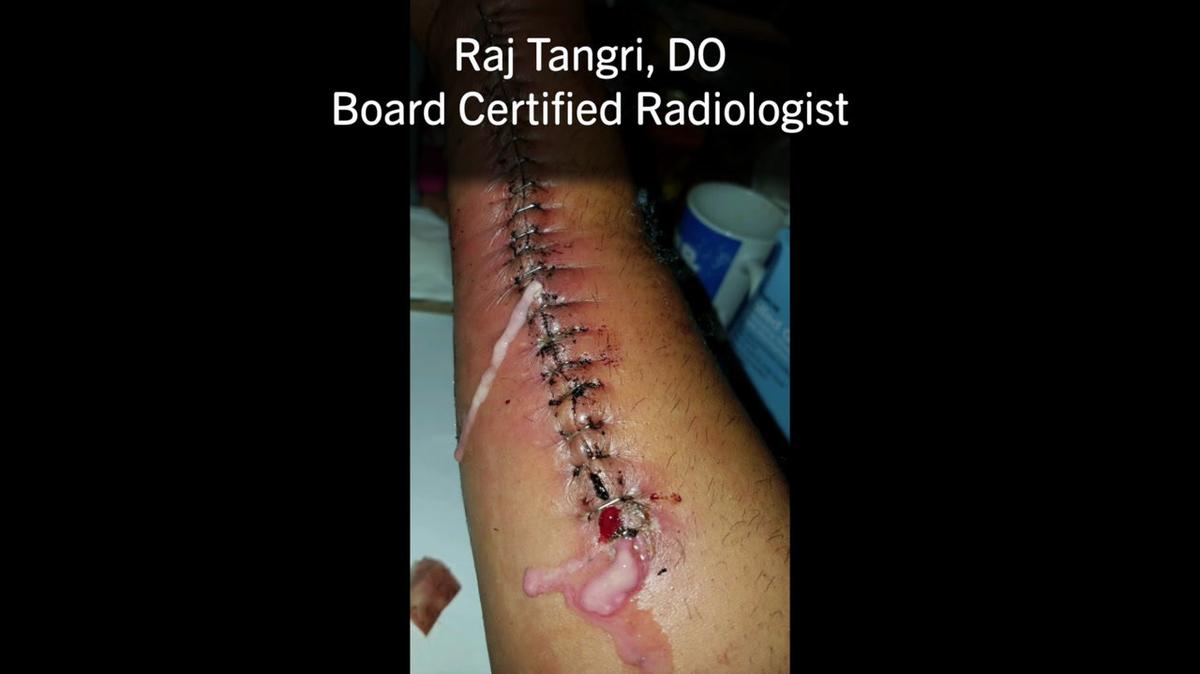 Dr. Raj Tangiri Recovery from Nerve Damage and then decides to become a practitioner