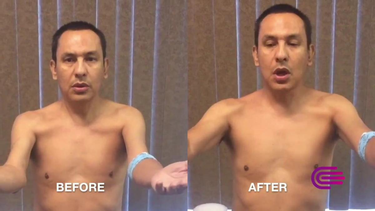 Essential Tremor Before/After