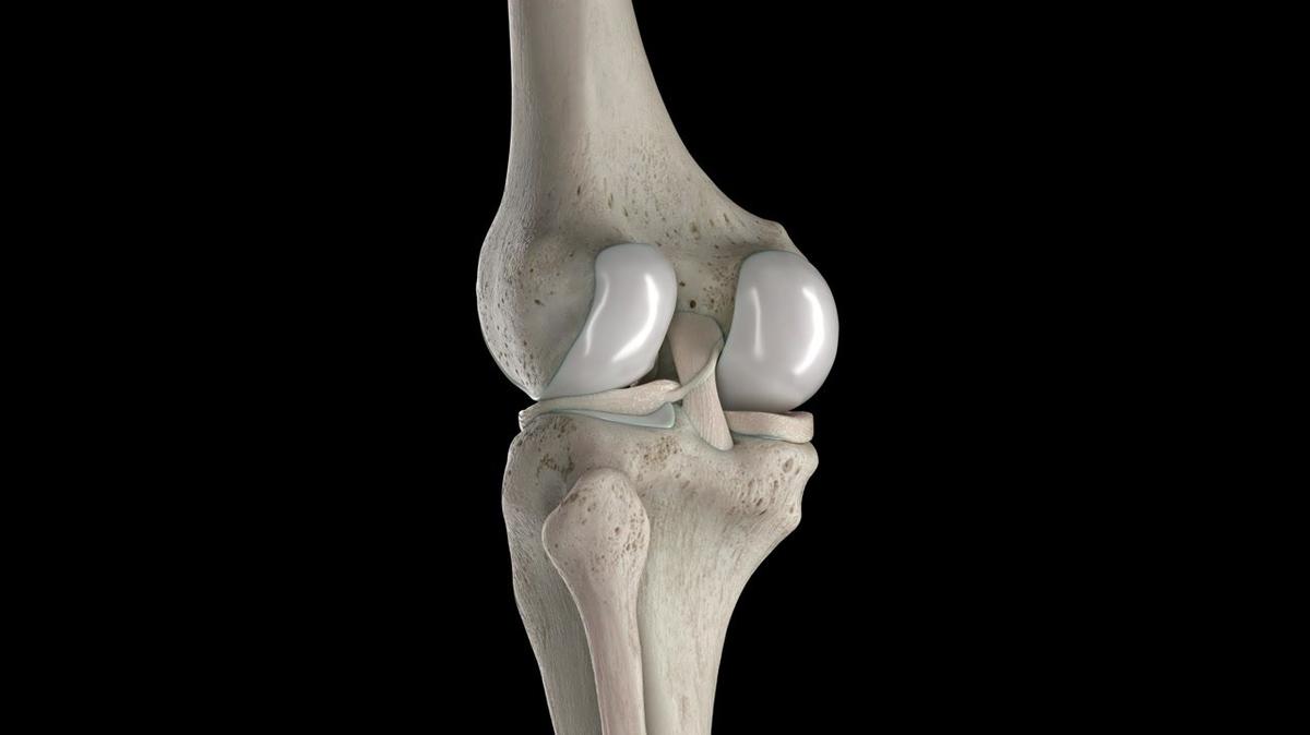 3D rendered medical animation of damaged knee cartilage