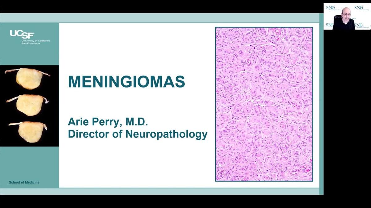 Meningiomas SNO Lecture (Arie Perry).mp4