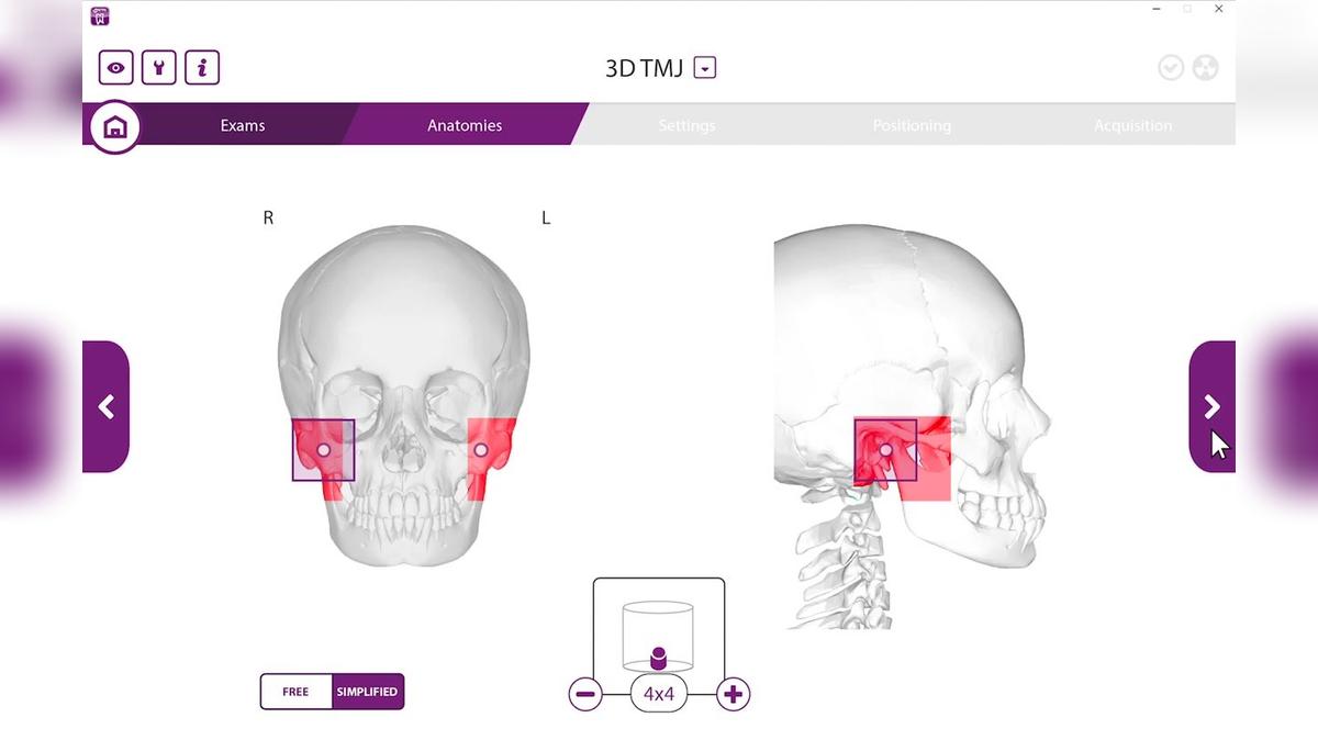 Hyperion X9 PRO 3D TMJ Acquisition