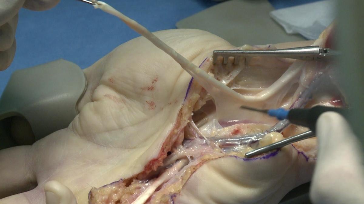 Surgery in an operating room/separation of the tendon using electrocautery