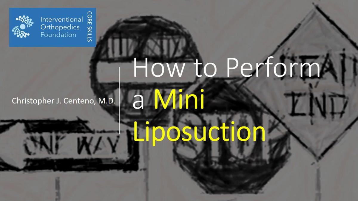 WEBINAR SERIES Part 4 - How to Perform a Mini-Lipo Aspiration.mp4