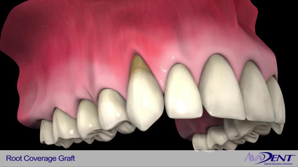 Root_Coverage_Graft.mp4