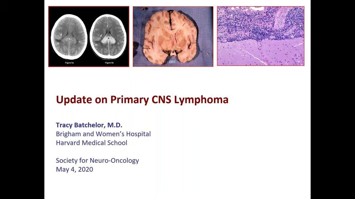 SNO Webinar Series_ Primary CNS Lymphoma_ An Update on Diagnosis and Management.mp4