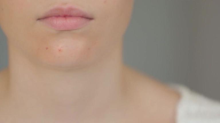 Pickel am Kinn: Das verrät dein Gesicht über deine Gesundheit