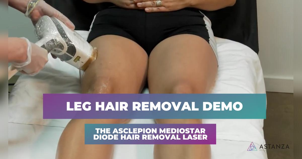 Asclepion MeDioStar Demo with Carolyn Webb, RN
