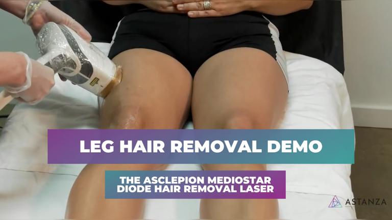 Asclepion MeDioStar Demo with Carolyn Webb, RN