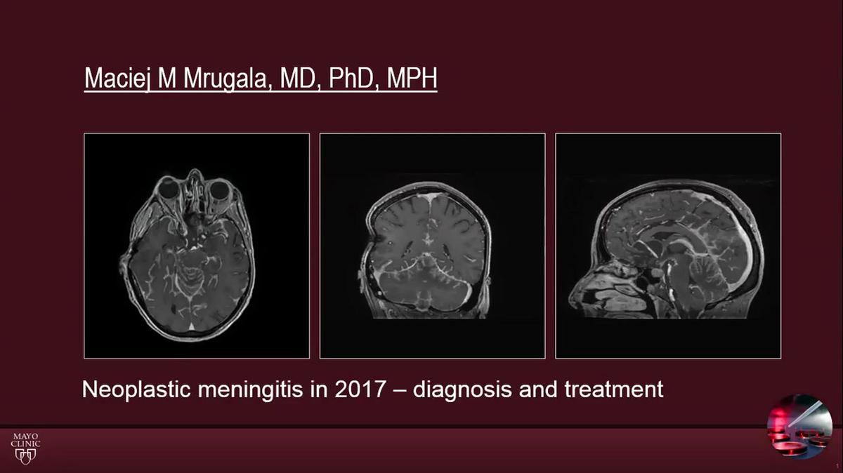 Neoplastic Meningitis in 2017 - Diagnosis and Treatment