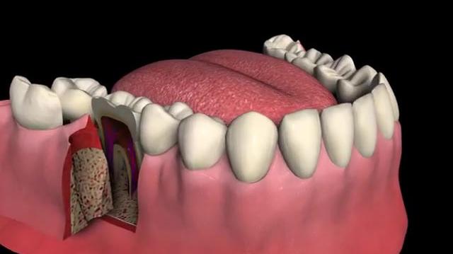 Cross_Section_of_an_Infected_Tooth.mp4