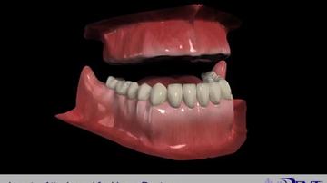 Locator_Attachments_for_Upper_Denture.mp4