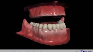 Locator_Attachments_for_Upper_Denture.mp4