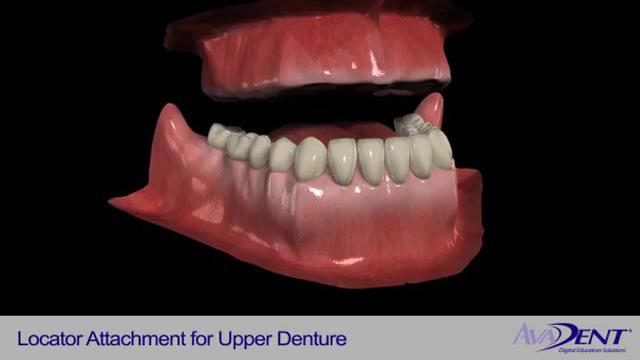 Locator_Attachments_for_Upper_Denture.mp4