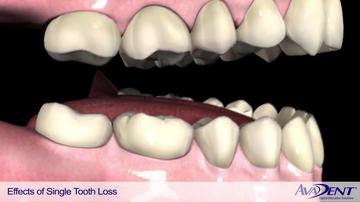 Effects_of_Single_Tooth_Loss.mp4