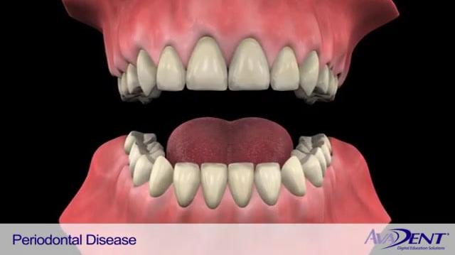 Periodontal_Disease.mp4