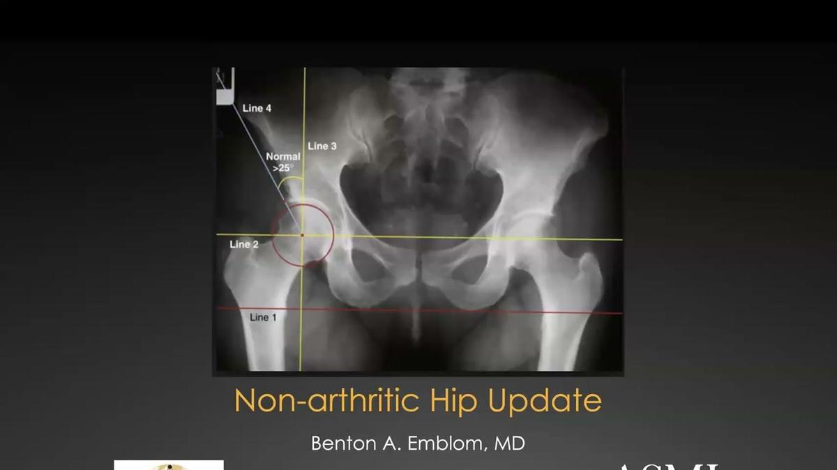 Non-Arthritic Hip Update
