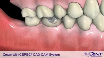 Crown_with_CEREC_CAD_-_CAM_System.mp4